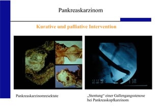 UKA Medizinische Klinik III RWTH Aachen
„Stentung“ einer Gallengangsstenose
bei Pankreaskopfkarzinom
Pankreaskarzinomresektate
Pankreaskarzinom
Kurative und palliative Intervention
 