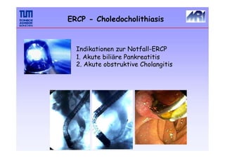 ERCP - Choledocholithiasis
Indikationen zur Notfall-ERCP
1. Akute biliäre Pankreatitis
2. Akute obstruktive Cholangitis
 