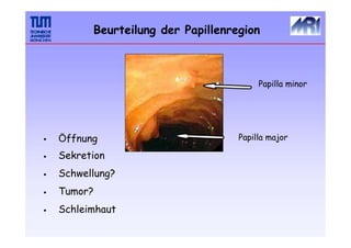 Beurteilung der Papillenregion
Papilla minor
Papilla major
•
•
•
•
•
Öffnung
Sekretion
Schwellung?
Tumor?
Schleimhaut
 