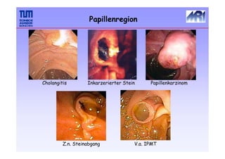 Papillenregion
Cholangitis Inkarzerierter Stein Papillenkarzinom
Z.n. Steinabgang V.a. IPMT
 