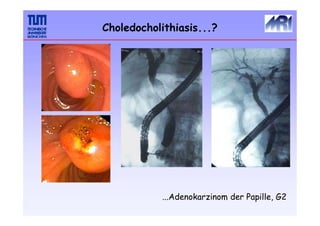 Choledocholithiasis...?
...Adenokarzinom der Papille, G2
 
