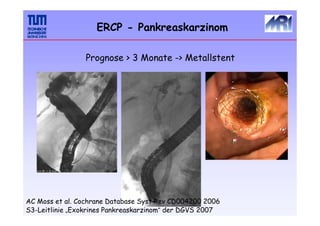 ERCP - Pankreaskarzinom
Prognose > 3 Monate -> Metallstent
AC Moss et al. Cochrane Database Syst Rev CD004200 2006
S3-Leitlinie „Exokrines Pankreaskarzinom“ der DGVS 2007
 