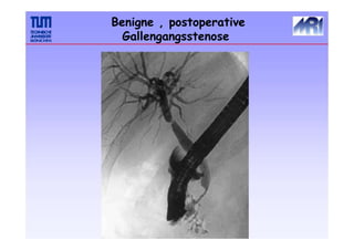 Benigne , postoperative
Gallengangsstenose
 