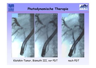 Photodynamische Therapie
Klatskin-Tumor, Bismuth III, vor PDT nach PDT
 
