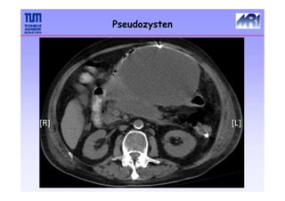 Pseudozysten
 