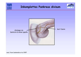 duct fusion
drainage via
Santorini & minor papille
mod. from Soehendra et al 1997
Inkomplettes Pankreas divisum
 