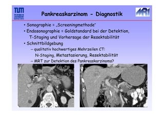 • Sonographie = „Screeningmethode“
• Endosonographie = Goldstandard bei der Detektion,
T-Staging und Vorhersage der Resektabilität
• Schnittbildgebung
– qualitativ hochwertiges Mehrzeilen CT:
N-Staging, Metastasierung, Resektabilität
– MRT zur Detektion des Pankreaskarzinoms?
Pankreaskarzinom - Diagnostik
 