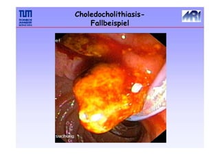 Choledocholithiasis-
Fallbeispiel
 