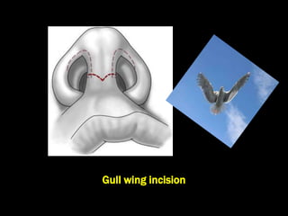 Gullwing Incision Rhinoplasty 15. Principles of Rhinoplasty.ppt