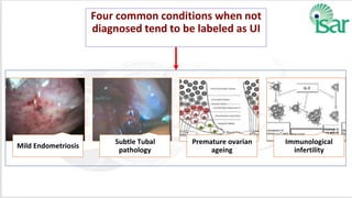 Four common conditions when not
diagnosed tend to be labeled as UI
 