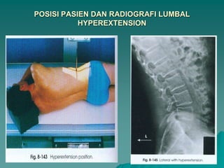 15.LUMBAL BENDING.pptx