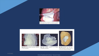 16
6/22/2022
Clinical Maxillofacial Prosthesis - Thomas D Taylor
 