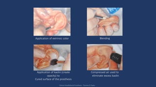 Application of extrinsic color Blending
Application of kaolin (create
opacity) to
Cured surface of the prosthesis
Compressed air used to
eliminate excess kaolin
Clinical Maxillofacial Prosthesis - Thomas D Taylor
 