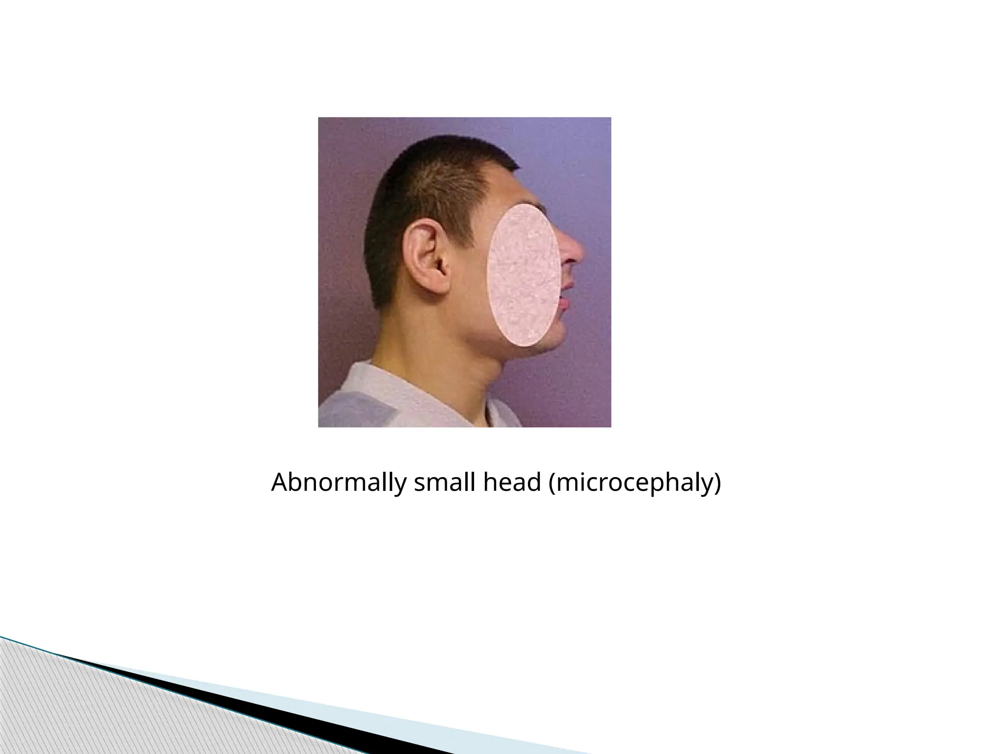 Abnormally small head (microcephaly)
 