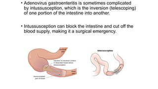 Inversion Intestine Gastroenteritis Viruses: Causes, Transmission, Symptoms, and Prevention ...
