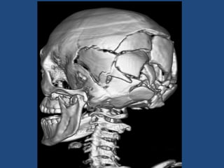 Skull Potential Injuries Comprehensive Overview of Craniocerebral Injuries: Types, Mechanisms ...