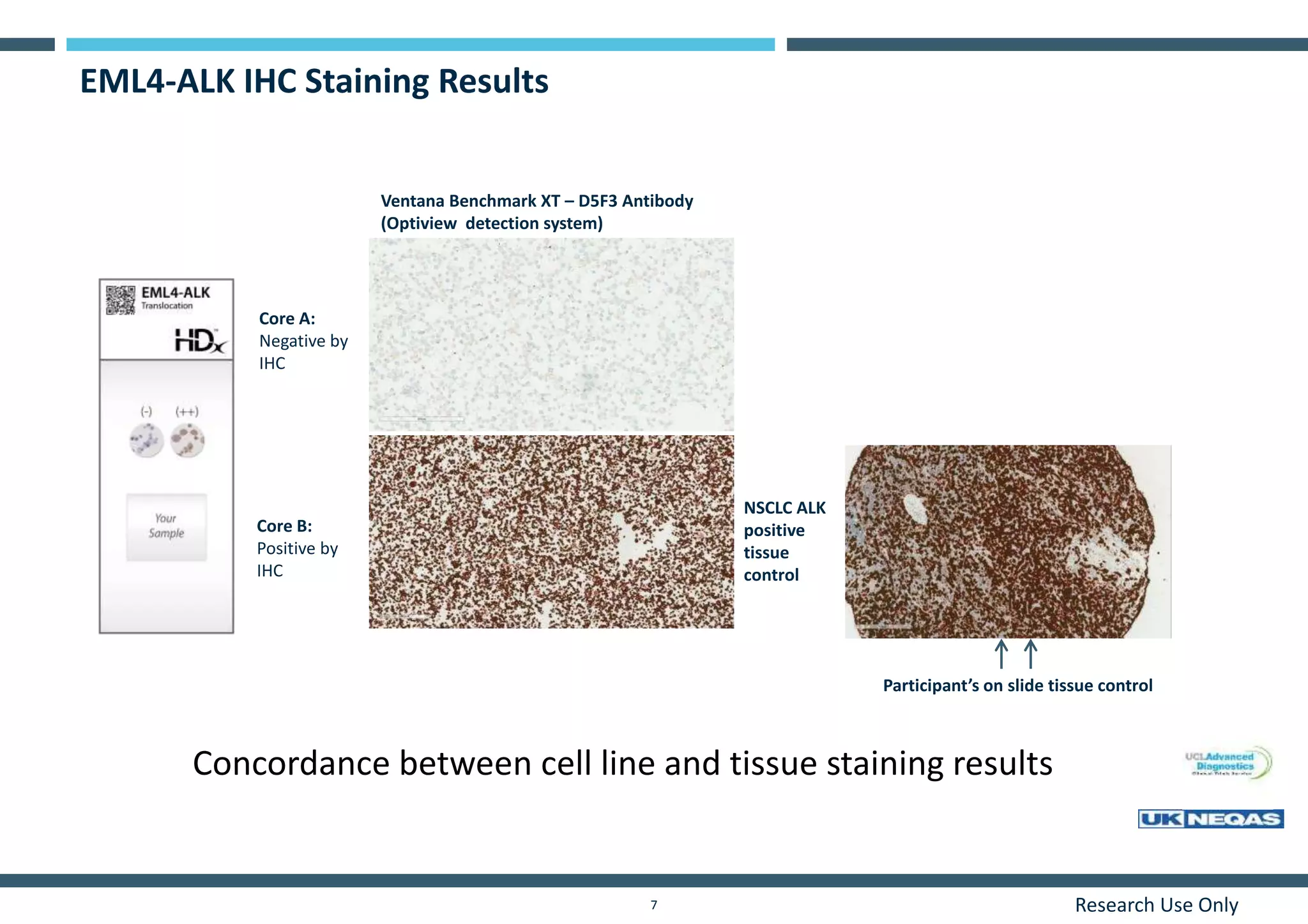 Research Use Only7
EML4-ALK IHC Staining Results
Core A:
Negative by
IHC
NSCLC ALK
positive
tissue
control
Core B:
Positive by
IHC
Participant’s on slide tissue control
Ventana Benchmark XT – D5F3 Antibody
(Optiview detection system)
Concordance between cell line and tissue staining results
 