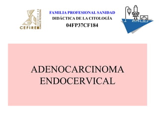 FAMILIA PROFESIONAL SANIDAD,[object Object],DIDÁCTICA DE LA CITOLOGÍA,[object Object],04FP37CF184,[object Object],ADENOCARCINOMA ENDOCERVICAL,[object Object]