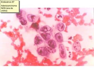 Cromatina de distribución irregular, areas claras, cromatina marginada gruesa e irregular (membrana nuclear irregularmente engrosada). Citología de Adenocarcinoma:Desorden celular y nuclear.Cierta polaridad nuclear, sobre todo en el borde de los grupos.Placas poco cohesivas, Células tumorales aisladas (criterio fundamental en mama)Células aisladas con citoplasma alargado o columnar.Grupos tridimensionales moruliformesEstructuras acinares o en rosetaCitoplasmas claros, vacuolados o microvacuolados, de bordes mal definidos.Moco:Extracelular (en Carcinoma Coloide de mama)