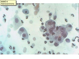 morfología en “anillo de sello” (estómago, lobulillar de mama)En adenocarcinomas papilares:Estructuras papilares con eje conectivo central y revestimiento epitelial tumoral.