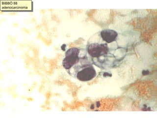 cuerpos de “psammoma”, calcificados, concéntricos.