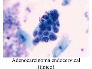 “puentes celulares” entre grupos en forma de “placas”.Citología del Adenocarcinoma infiltrante (Dr. De  Agustí)Grupos tridimensionales :límites citoplásmicos borradosNúcleos excéntricos, cromatina no muy grosera, nucleolos prominentesDiátesis tumoralCitoplasmas vacuolados ( a veces en anillo de sello)