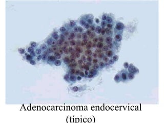 Endocérvix 87Adenocarcinoma NOS (era de uretra)