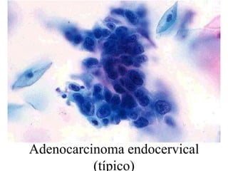 Células cilíndricas malignas