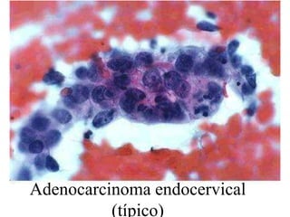 BIBBÓ 6 Adenocarcinoma