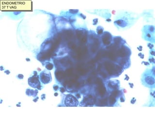 Ha aumentado su frecuencia en los últimos años. Hay que señalar que ha disminuido  el número del Carcinoma epidermoide de cérvix.