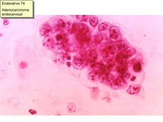 30 % de los Adenocarcinomas infiltrantes de cérvix 