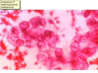 y 75 % de los Adenocarcinomas “in situ”.