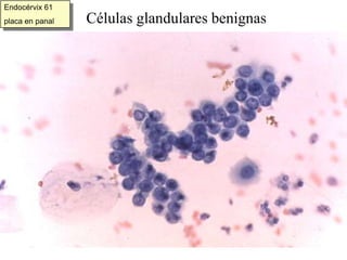 Endocérvix 61placa en panalCélulas glandulares benignas