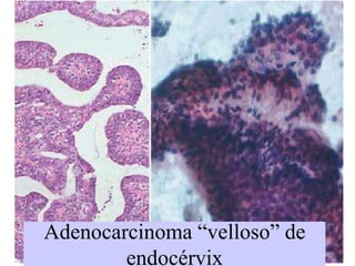 Los subtipos de HPV que se observan en relación con Adenocarcinoma son los 16 y 18.Adenocarcinoma endocervicalDiátesis tumoral, pero en menor proporción que en el Carcinoma epidermoide