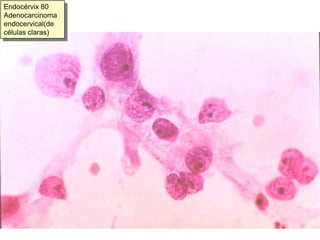 Grupos planos irregulares, formaciones papilaroides, acúmulos tridimensionales o más rara vez, células aisladas.