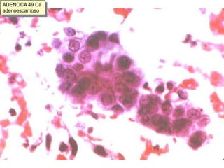 Núcleos grandes (más que los del Ca. Endometrial)Contrariamente a lo que cabría esperar (ya que el mucinoso es el tipo más frecuente) rara vez se observan vacuolas en la citología del Adenocarcinoma endocervical Macronucleolos y nucleolos múltiplesCromatina irregularmente granular con aclaramiento paracromatínico e hipercromatismoCitoplasmas columnares eosinófilos o basófilos