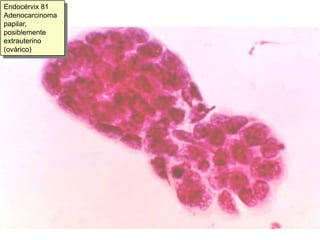 Adenocarcinoma endocervical (típico)