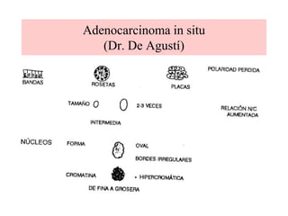 Adenocarcinoma endocervical (típico)