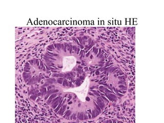 Adenocarcinoma endocervical (células columnares malignas)
