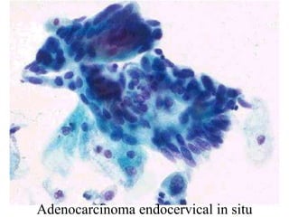 Adenocarcinoma endocervical, en técnica monocapa (tridimensionalidad y núcleos poco visibles)