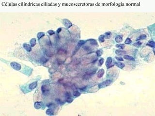 Células cilíndricas ciliadas y mucosecretoras de morfología normal