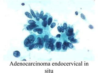 AdenocarcinomaEndometrio           //           EndocérvixToma vaginalEscasas célulasGrupos con forma de esferasCélulas más pequeñas con citoplasma más escasoMal conservadas Células redondeadas con vacuolasNúcleo grande, irregular, con granos finos.Nucleolo solitario, si lo hay.Necrosis y sangreEn la toma endocervical
