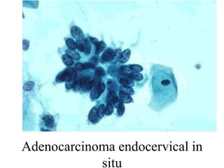 Células mayores con citoplasmas amplios 