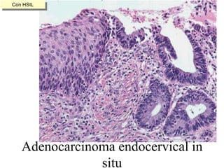 Células columnares y citoplasma granular