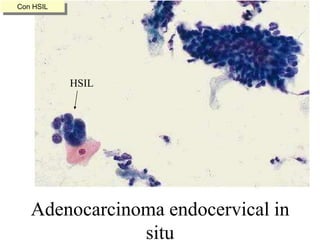 Núcleo muy grande, oval o irregular, cromatina grosera