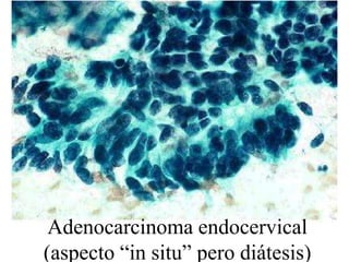 Macronucleolo o nucleolos múltiples.