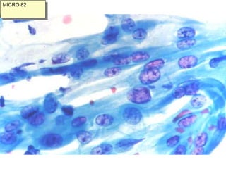 Tipos de Adenocarcinoma de cérvixAdenocarcinoma mucinoso:o       De tipo endocervical (similar al epitelio cilíndrico endocervical)Variante con mínima atipia (adenoma maligno)