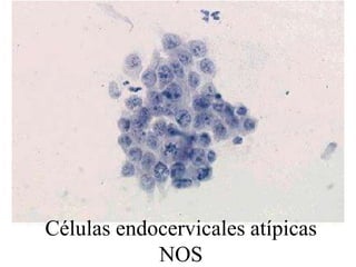 De tipo intestinal (con células columnares y mucosecretoras similares a las del intestino)Adenocarcinoma endometrioide (similar al de endometrio)Adenocarcinoma de tiposeroso(similar al seroso ovárico)Adenocarcinoma villoglandular(similar al tumor velloso intestinal, con numerosas papilas)Adenocarcinoma de células claras (dietilestilbestrol)Carcinoma adenoescamosoVariante poco diferenciada: Carcinoma de células esmeriladas (glassy cell carcinoma)Carcinoma adenoide quístico.(más frecuente en salivares, también se da en mama y en tráquea)Adenocarcinoma de los conductos de Gartner (muy raro)