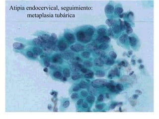 Endocérvix 74Adenocarcinoma endocervical