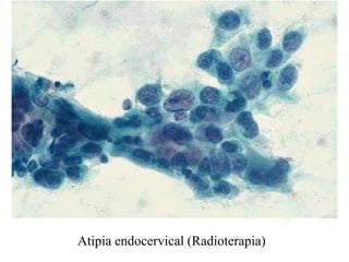 Endocérvix 77 Adenocarcinoma endocervical